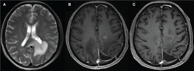 Review of tracer kinetic models in evaluation of gliomas using dynamic contrast-enhanced imaging